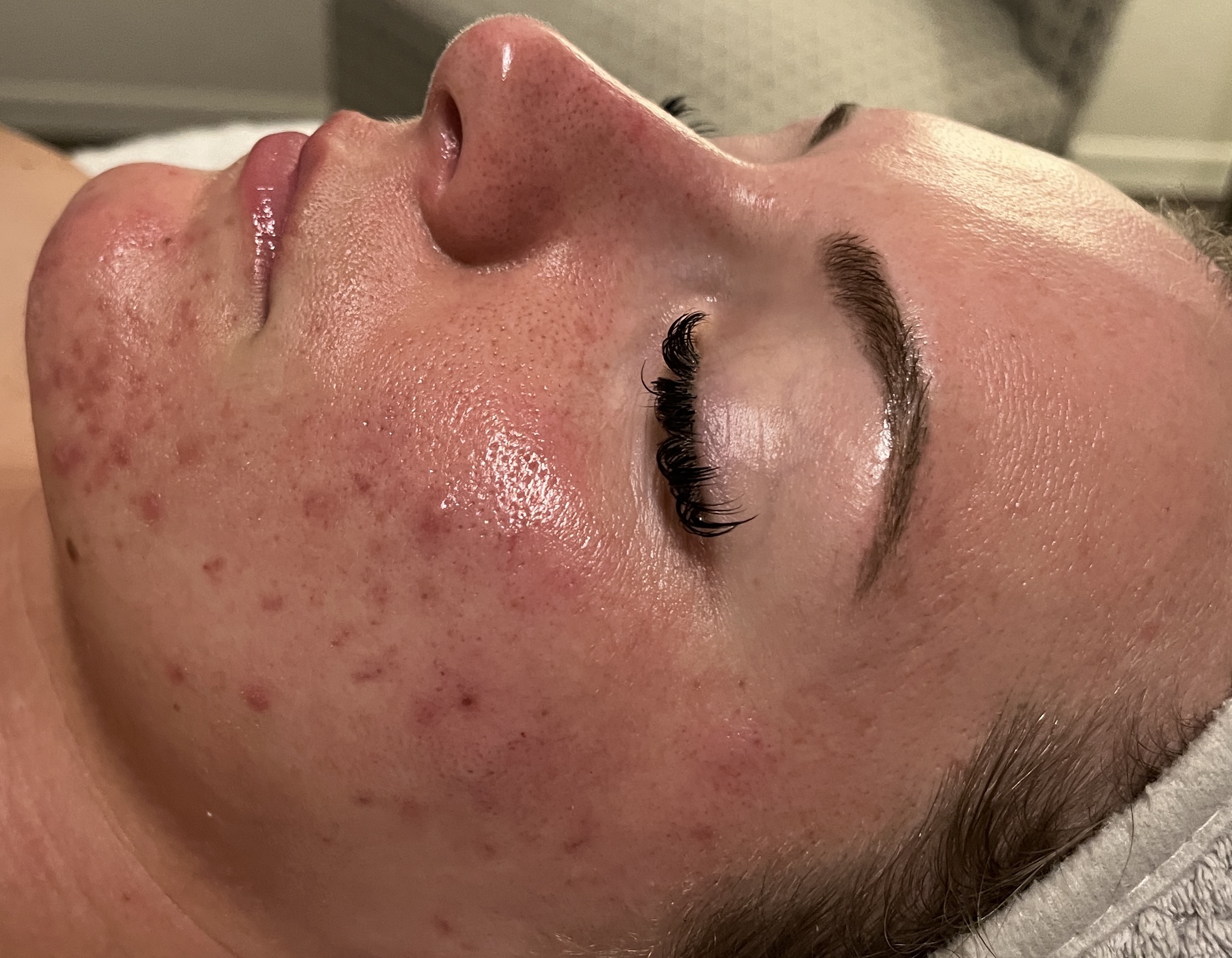 acne bootcamp before picture